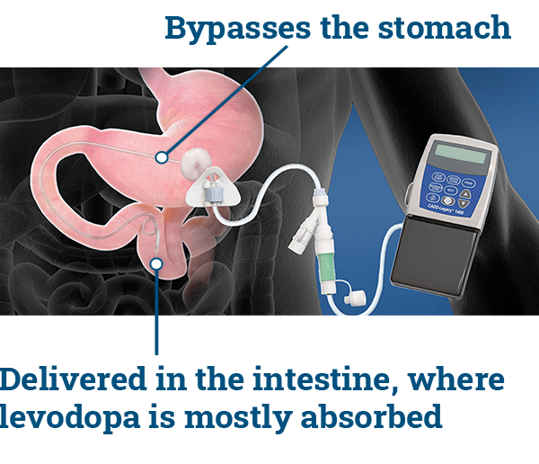 Duopa Bypasses Stomach, Delivered in Intestine