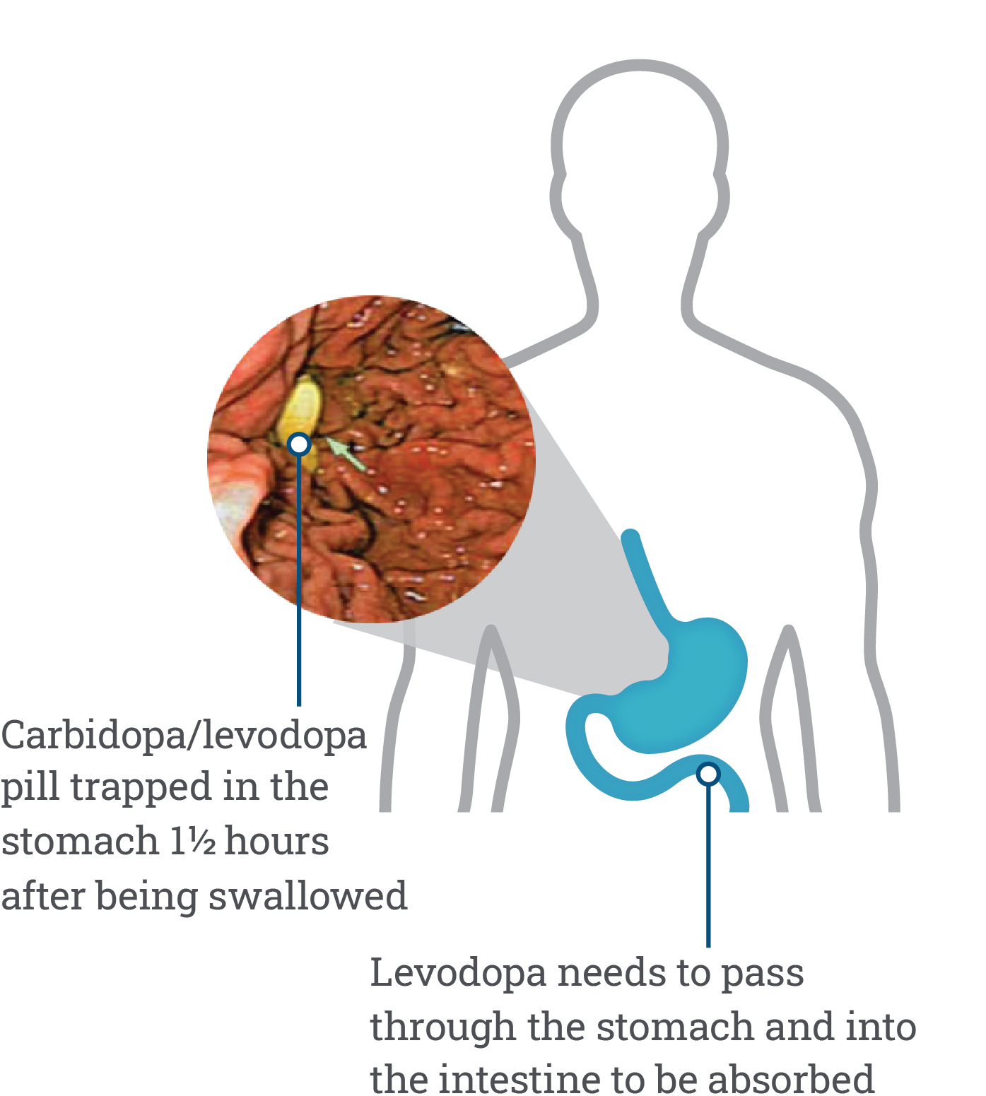 Advanced Parkinson’s Stomach Issues